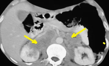 ADRENAL LYMPHOMA