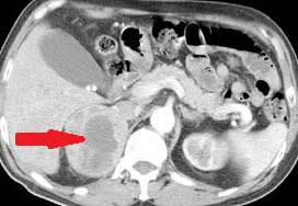 SILENT PHEOCHROMOCYTOMA