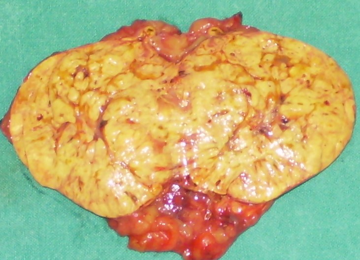 CORTISOL PRODUCING ADENOMA