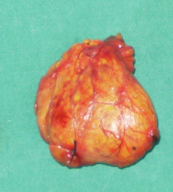CORTISOL PRODUCING ADENOMA