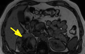 ADRENAL MYELOLIPOMA