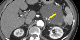ADRENAL LYMPHANGIOMA