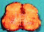 ALDOSTERONOMA