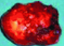 ALDOSTERONOMA