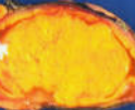 ALDOSTERONOMA