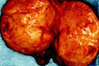 ALDOSTERONOMA