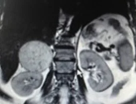ADRENAL PHEOCHROMOCYTOMA