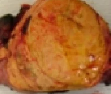 ADRENAL PHEOCHROMOCYTOMA