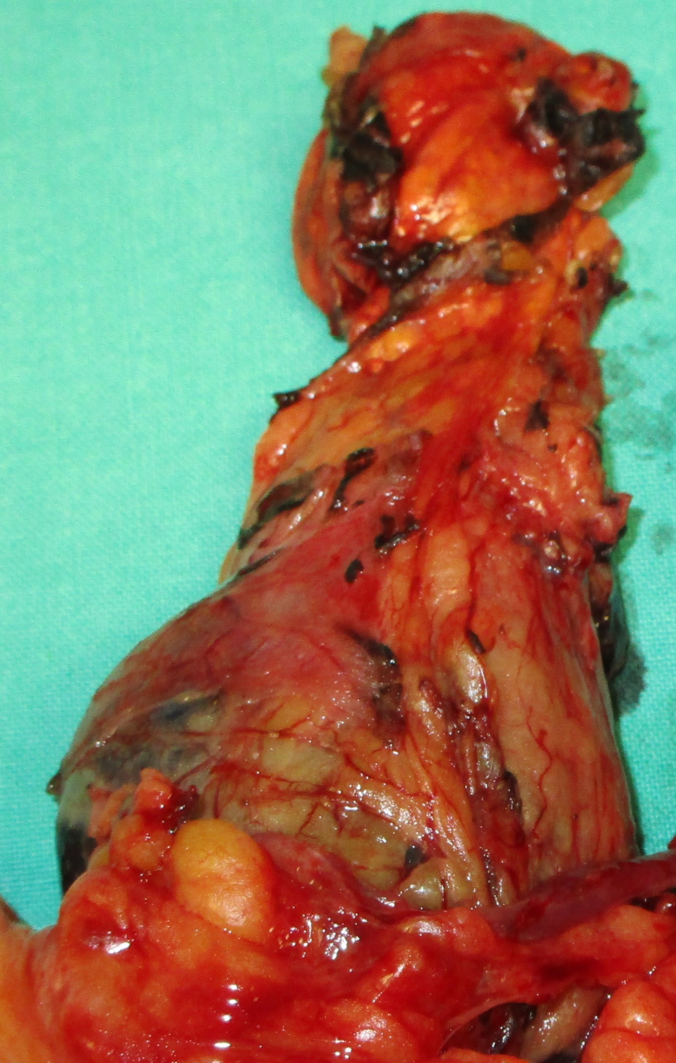 CYSTIC  PHEOCHROMOCYTOMA
