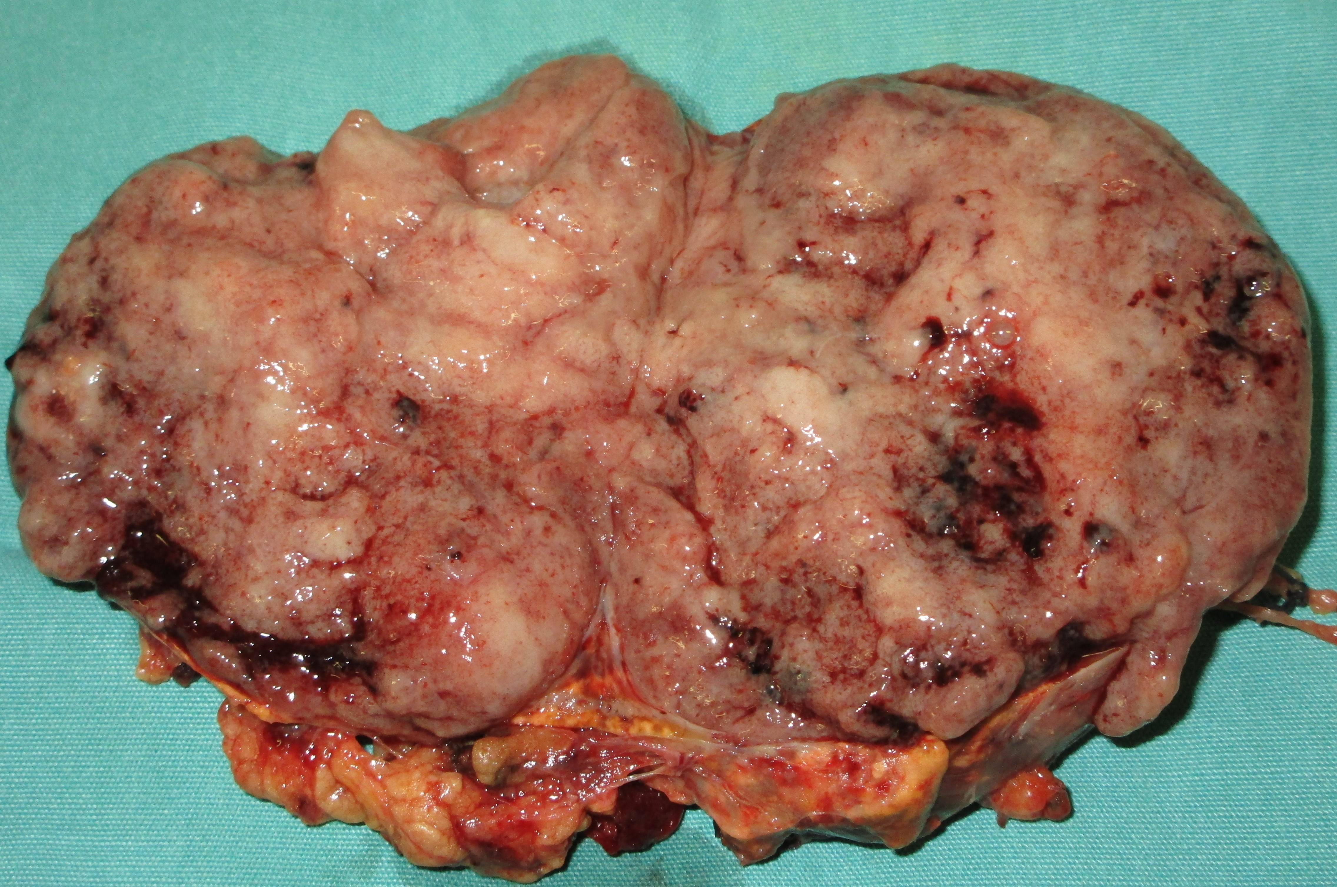 SILENT PHEOCHROMOCYTOMA