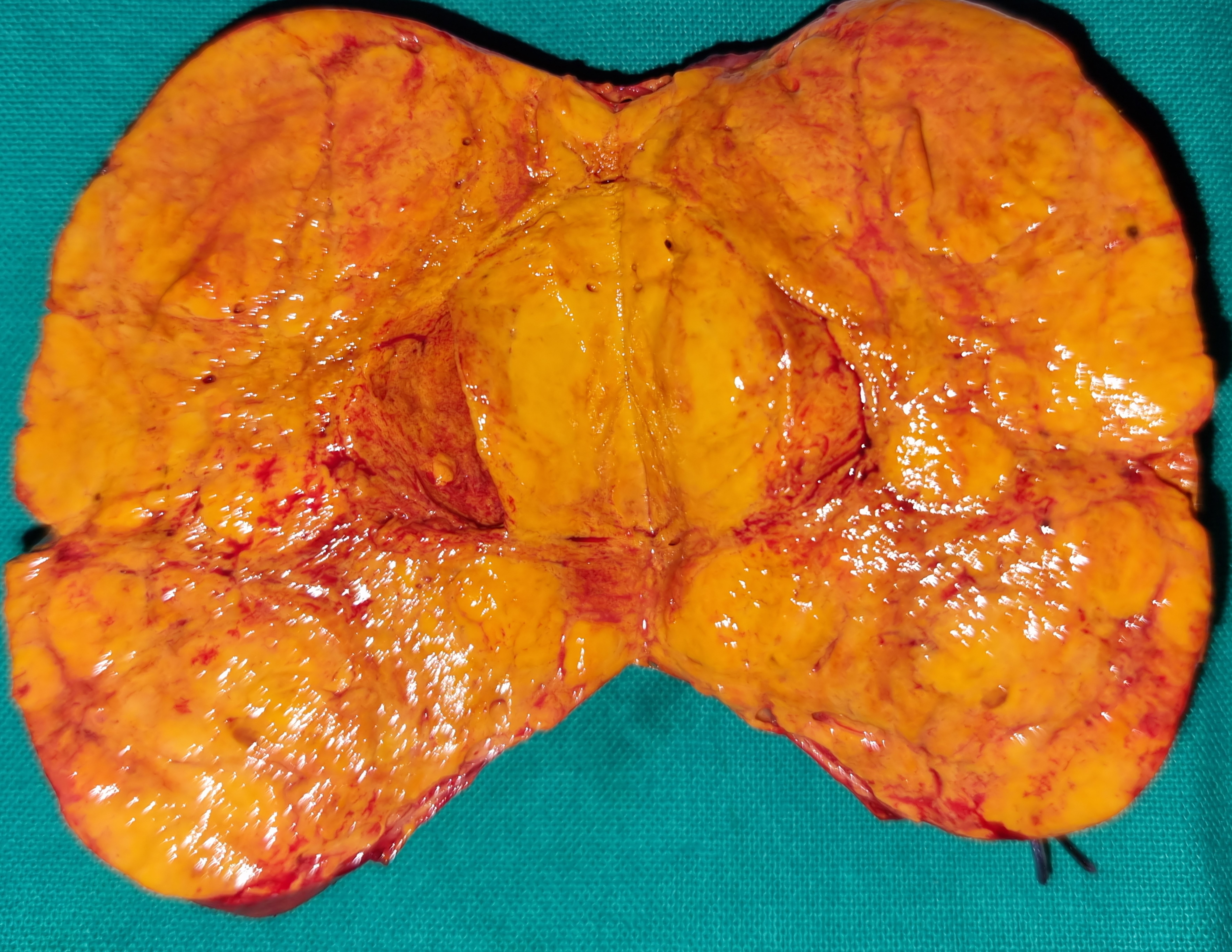 ADRENAL ADENOMA