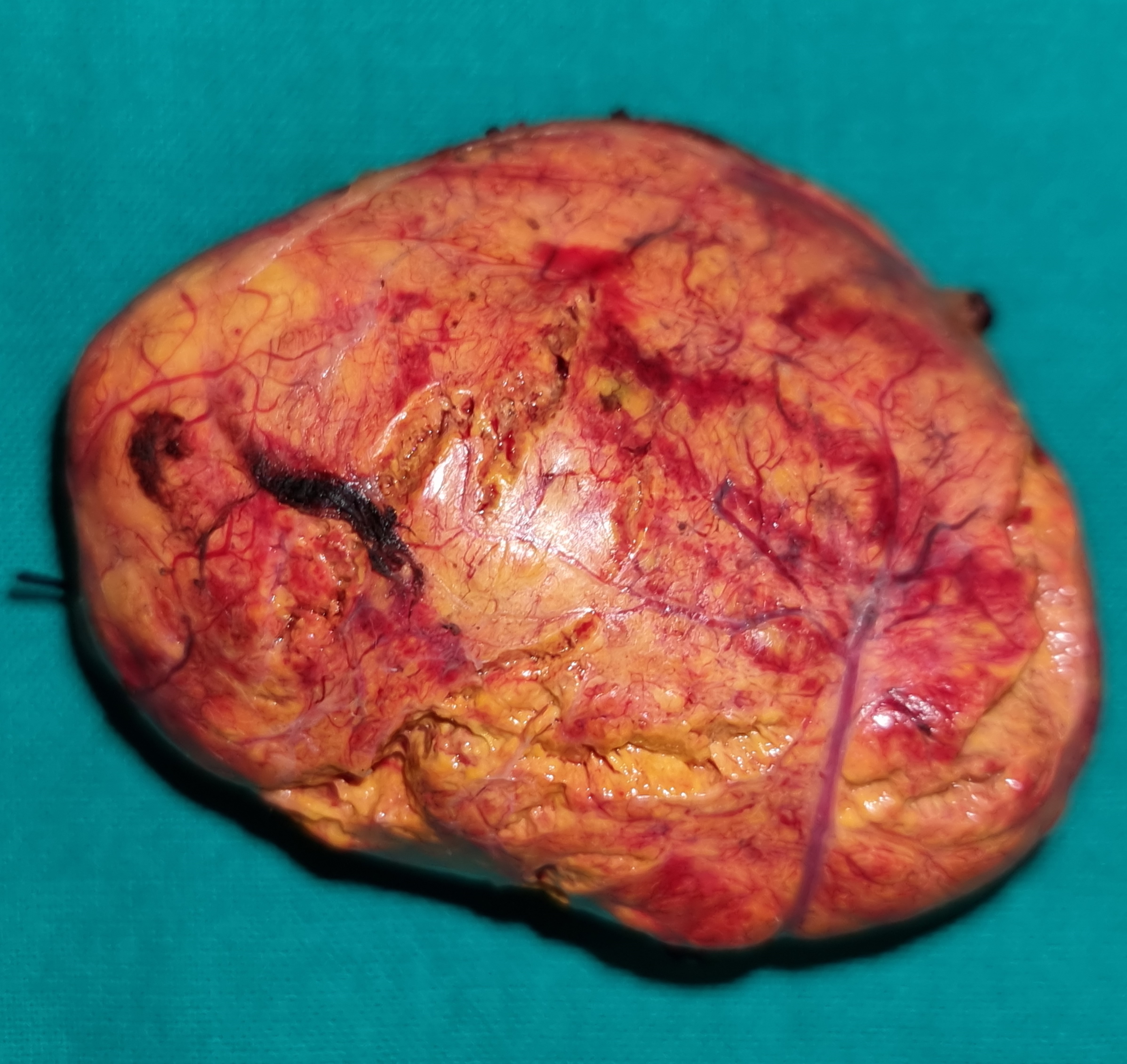 ADRENAL ADENOMA
