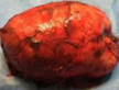 ADRENOCORTICAL CARCINOMA