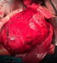 ADRENOCORTICAL CARCINOMA