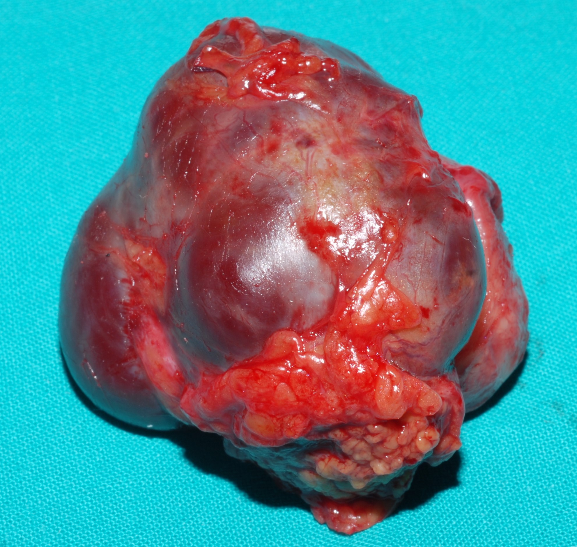 ADRENAL ADENOMA