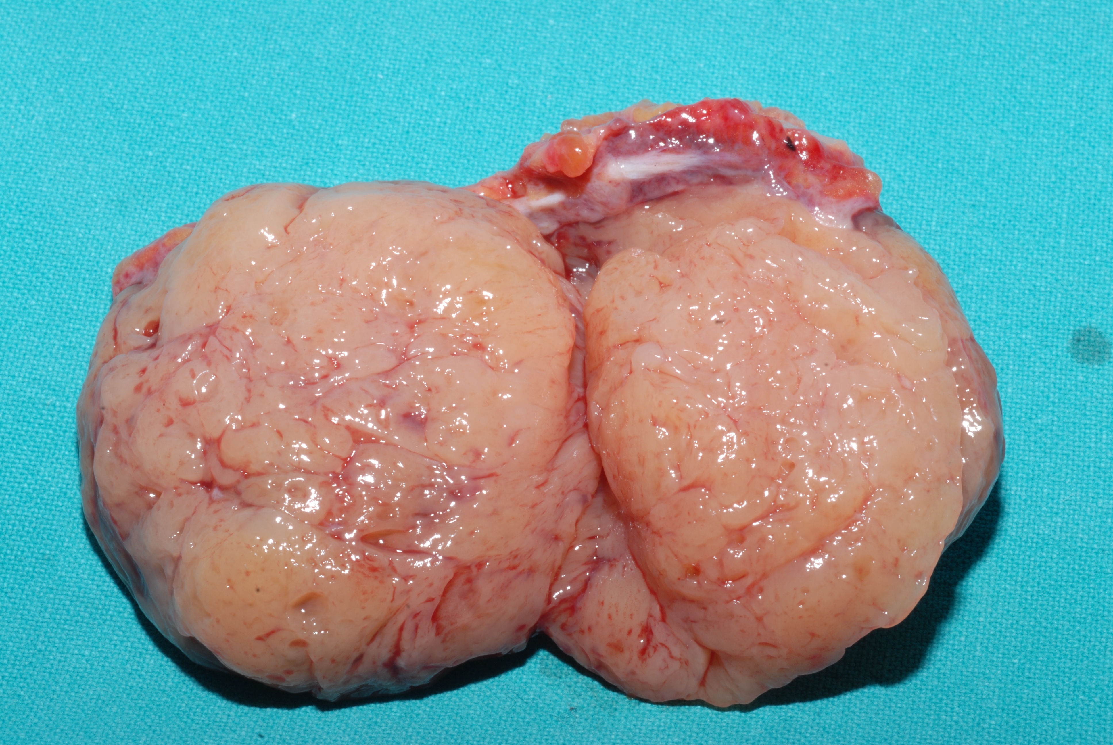 ADRENAL ADENOMA