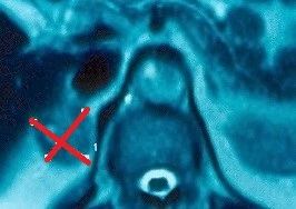 ADRENAL ADENOMA