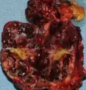 ADRENAL - METASTATIC RENAL CELL CARCINOMA