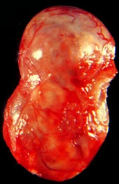 ADRENAL ADENOMA