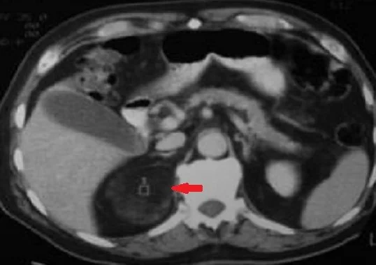 ADRENAL ANGIOMYOLIPOMA