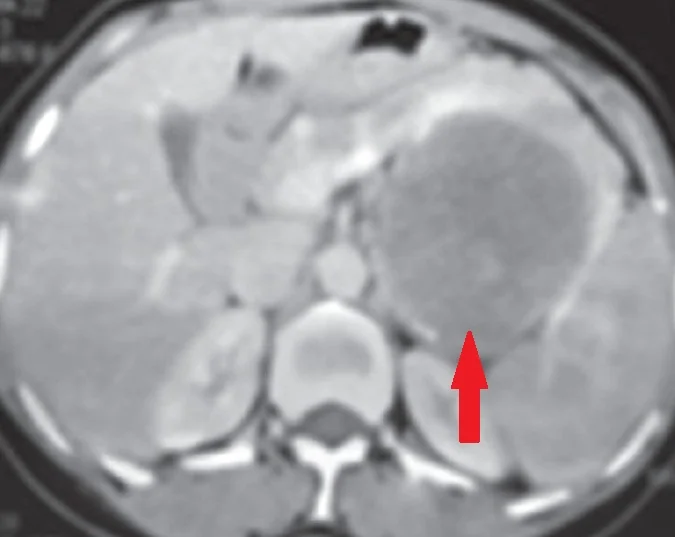 ADRENAL ANGIOMYOLIPOMA