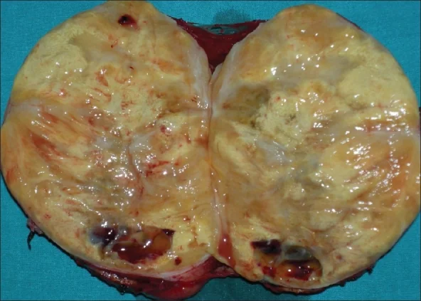 ADRENAL ANGIOMYOLIPOMA