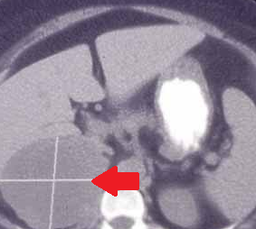 ADRENAL ADENOCARCINOMA