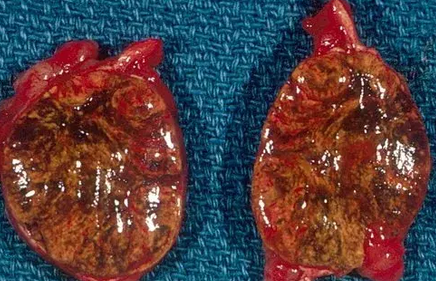 ADRENAL CORTICAL ADENOMA
