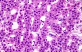 ADRENAL CORTICAL ADENOMA