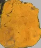 ADRENAL CORTICAL ADENOMA - CONN SYNDROME