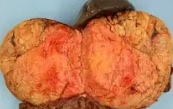 ADRENAL CORTICAL CARCINOMA