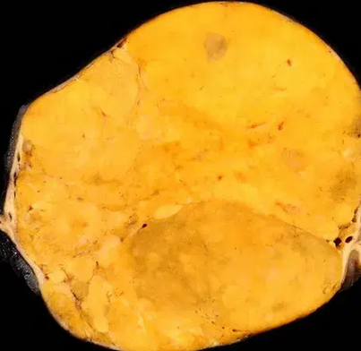 ADRENAL CORTICAL TUMOR