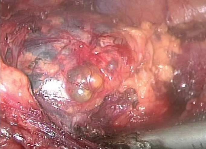 ADRENAL CYST