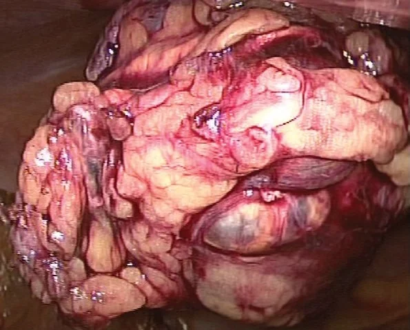 ADRENAL CYST