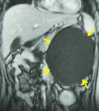 ADRENAL CYSTIC TUMOR