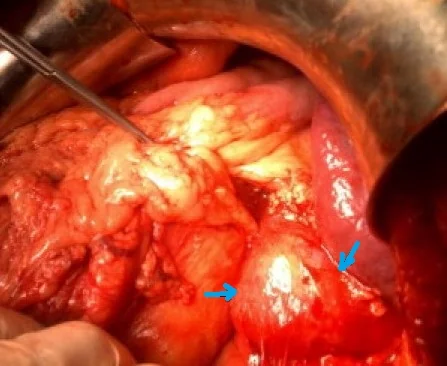 ADRENAL CYSTIC TUMOR