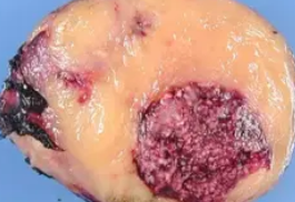 ADRENAL GANGLIONEUROBLASTOMA