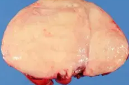 ADRENAL GANGLIONEUROBLASTOMA 