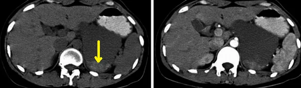 ADRENAL HEMOLYMPHANGIOMA