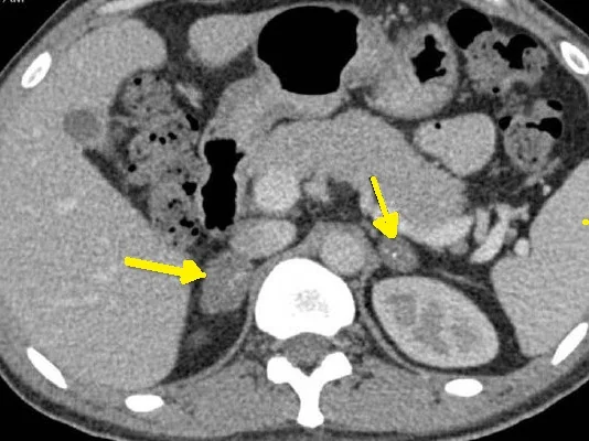 ADRENAL HISTOPLASMOSIS