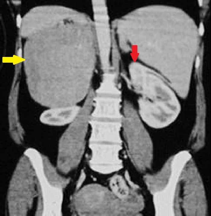 ADRENAL INCIDENTALOMA