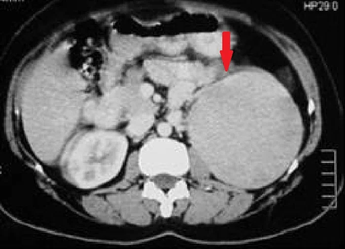 ADRENAL INCIDENTALOMA