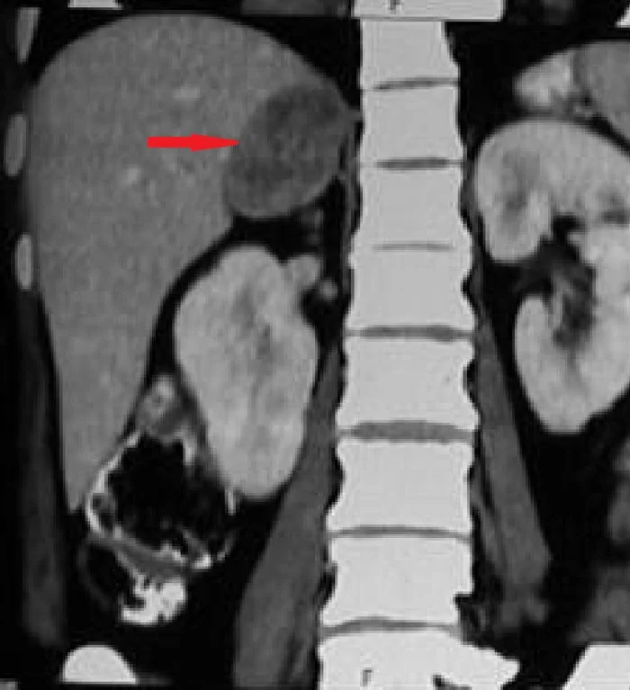 ADRENAL INCIDENTALOMA