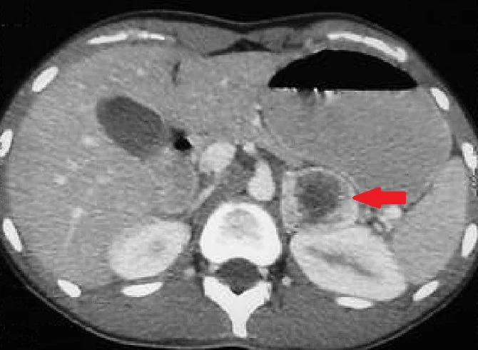 ADRENAL INCIDENTALOMA