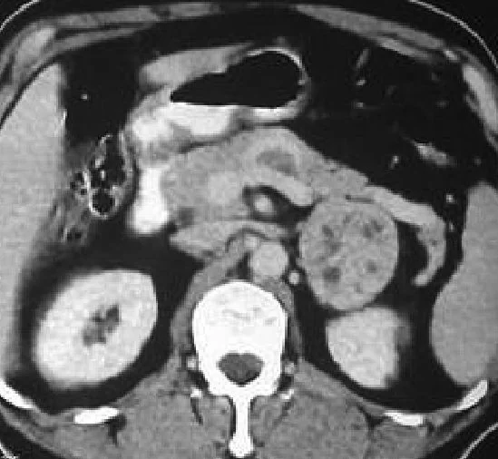 ADRENAL INCIDENTALOMA