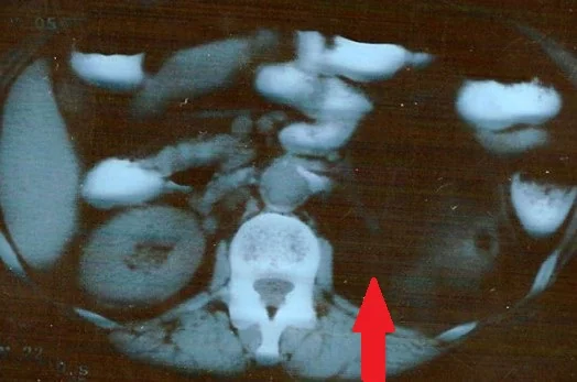 ADRENAL LIPOMA