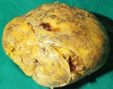 ADRENAL LIPOMA