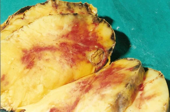 ADRENAL LIPOMA