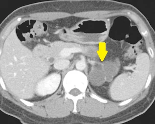 ADRENAL LYMPHANGIOMA