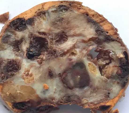 ADRENAL MYELOLIPOMA
